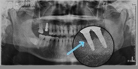 种植牙 邻牙 倾斜-图2 种植牙 邻牙 倾斜-图2