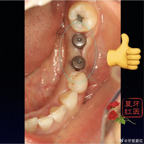 现在种植一颗牙-图2