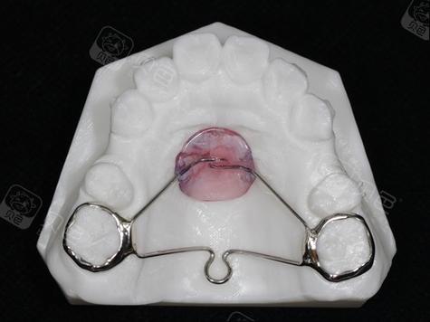 口腔正畸Nance弓的使用时机是什么时候?-图1 口腔正畸Nance弓的使用时机是什么时候?-图1