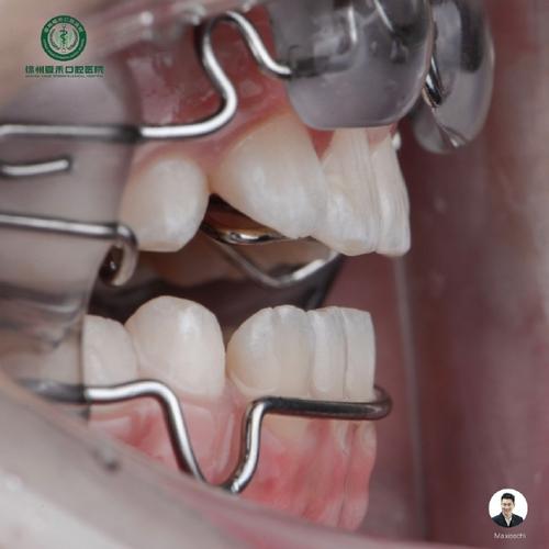 正畸术语Frankel的正确读音是什么？-图1