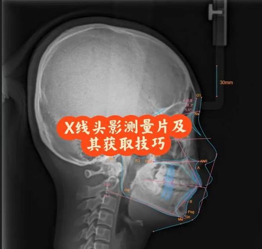 正畸头影测量McNamara-图3