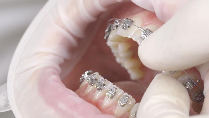 insignia精准正畸托槽如何实现牙齿精准矫正?-图3 insignia精准正畸托槽如何实现牙齿精准矫正?-图3