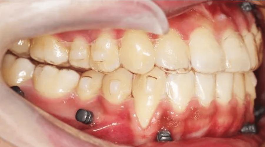 种在牙里面的钉子究竟有多长？-图2