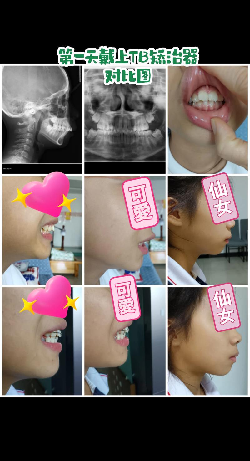 正畸tb功能性矫治器的适应症具体包括哪些临床适用情况？-图2