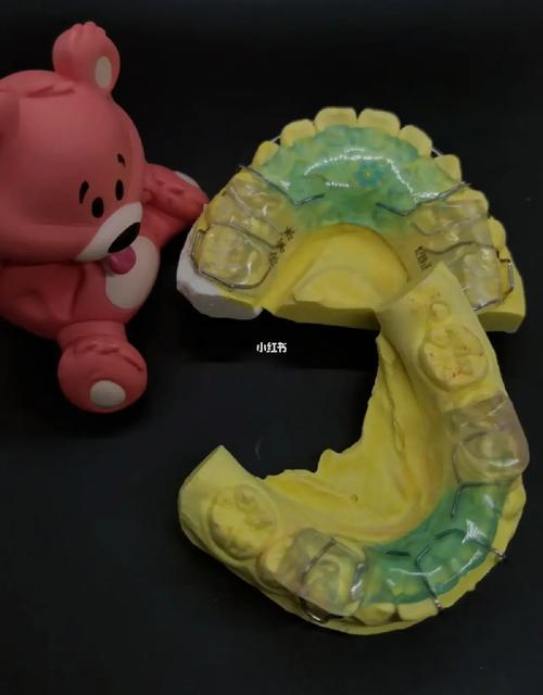 正畸tb功能性矫治器的适应症具体包括哪些临床适用情况?-图3 正畸tb功能性矫治器的适应症具体包括哪些临床适用情况?-图3