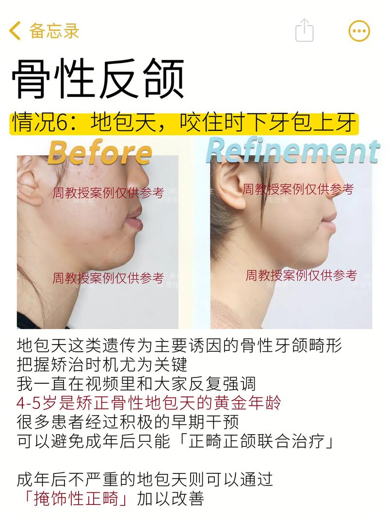 乳前牙反颌的矫治方法主要有哪些?-图3 乳前牙反颌的矫治方法主要有哪些?-图3