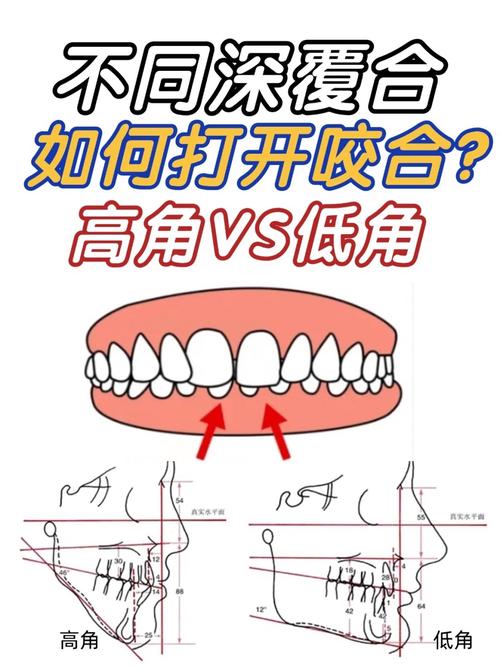 kq88正畸打开咬合的方法有哪些?-图1 kq88正畸打开咬合的方法有哪些?-图1
