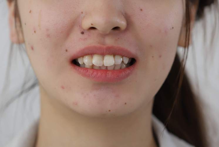 正畸III类倾向均角患者的矫治策略如何制定？-图1