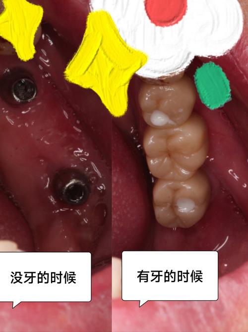 种牙后几天吃东西碰到了会有影响吗?-图2 种牙后几天吃东西碰到了会有影响吗?-图2