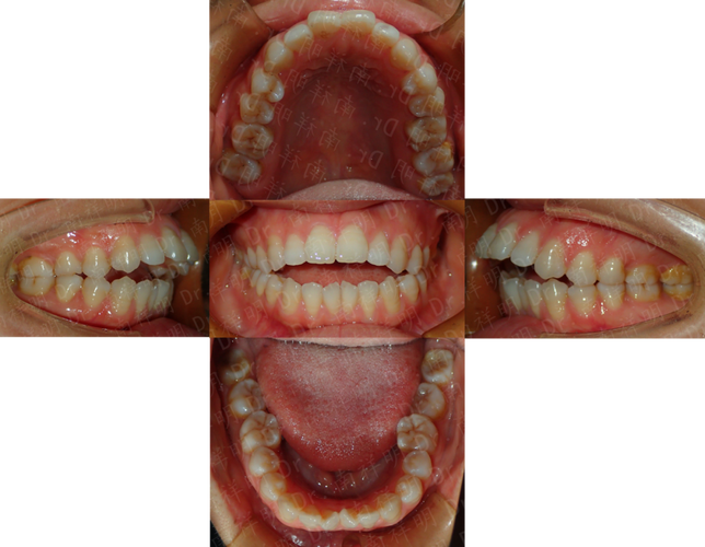 paoo手术中,正畸医生的参与是否为治疗过程中不可或缺的一环?-图3 paoo手术中,正畸医生的参与是否为治疗过程中不可或缺的一环?-图3