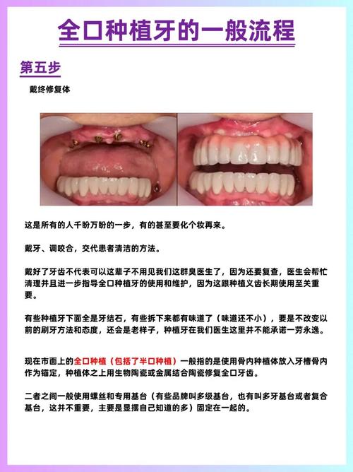 拜博口腔种牙为何被质疑打结?-图2 拜博口腔种牙为何被质疑打结?-图2