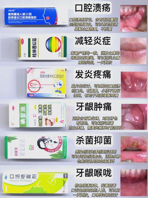 口臭口腔溃疡怎么治?有哪些有效的治疗方法?-图1 口臭口腔溃疡怎么治?有哪些有效的治疗方法?-图1