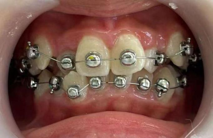 正畸治疗中MBT托槽粘结位置标准的临床应用关键要点有哪些？-图1