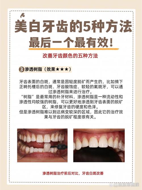美白牙齿哪种方法好？效果安全怎么选？-图3