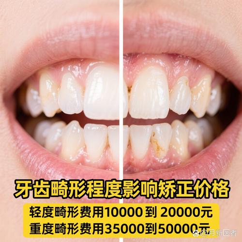 隐适美正畸一般要多少钱？费用受哪些因素影响？-图3