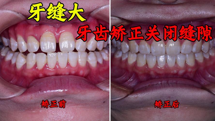 正畸关闭间隙两边不一致，原因何在？如何调整？-图2