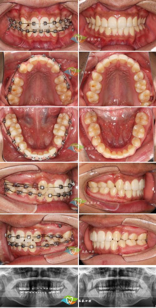 正畸关闭间隙两边不一致，原因何在？如何调整？-图1