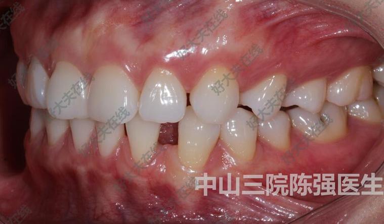 正畸关闭间隙两边不一致,原因何在?如何调整?-图3 正畸关闭间隙两边不一致,原因何在?如何调整?-图3
