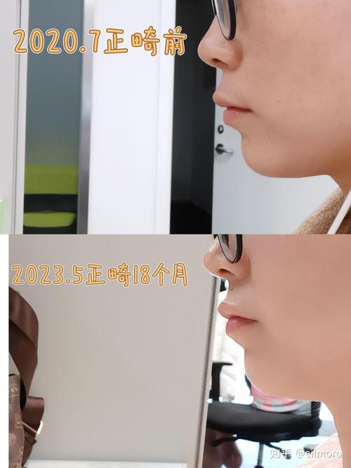 北大口腔第二门诊正畸有何优势？如何选择？-图1