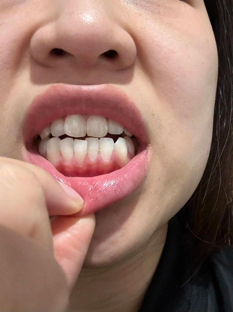 正畸后出现黑三角，该怎么解决？-图3