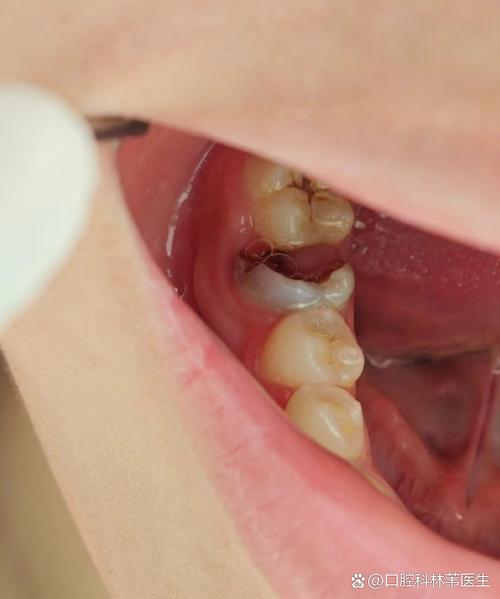 种牙后为何其它牙齿不舒服？是正常反应还是邻牙受影响？需要处理吗？-图3