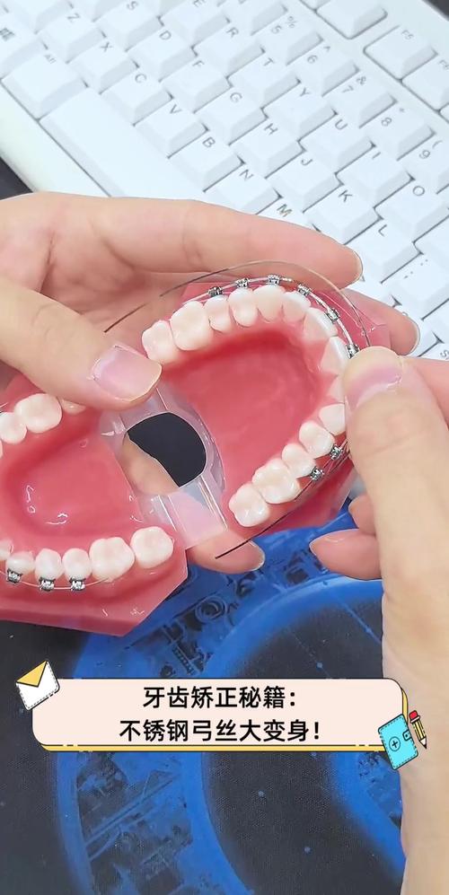 正畸弓丝为何要烧一下？这步操作对矫正有何关键作用？-图1