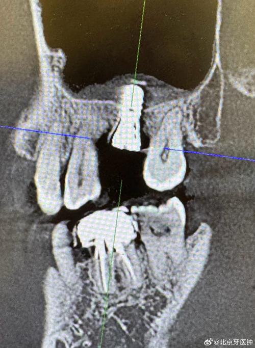 种牙上颌窦提升为何敲几下?敲击次数多少才合适?-图2 种牙上颌窦提升为何敲几下?敲击次数多少才合适?-图2
