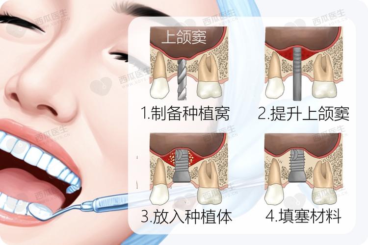 种牙上颌窦提升为何敲几下?敲击次数多少才合适?-图1 种牙上颌窦提升为何敲几下?敲击次数多少才合适?-图1