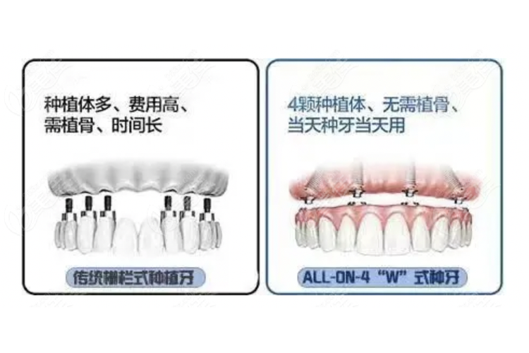 All-on-4种牙后使用有哪些关键注意事项？-图1