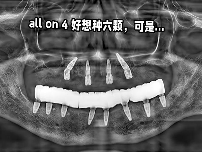 All-on-4种牙后使用有哪些关键注意事项？-图2