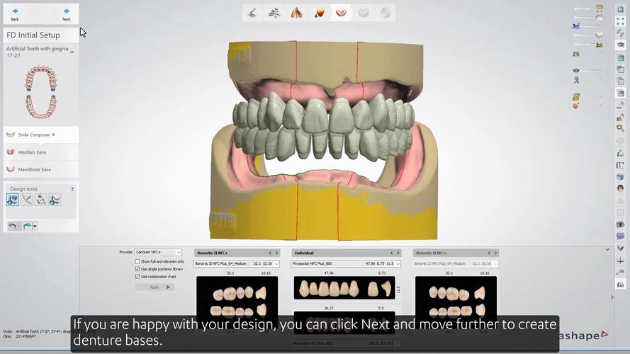数字化种植义齿制作方法的核心流程、技术要点及质量控制是什么？-图3