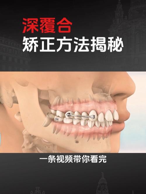 深覆颌活动矫正器的方法是什么?-图1 深覆颌活动矫正器的方法是什么?-图1