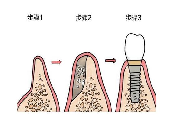 骨质条件差怎么种牙？安全有效的方法有哪些？-图2