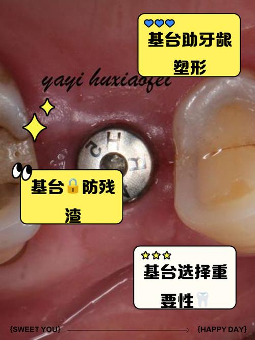 种植个性化基台制作需掌握哪些关键技术？-图1