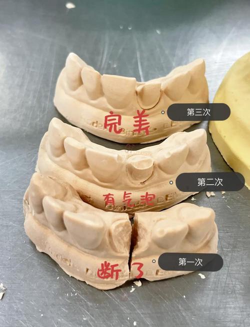 上颌牙局部义齿取模方法如何确保印模精准与舒适？-图2