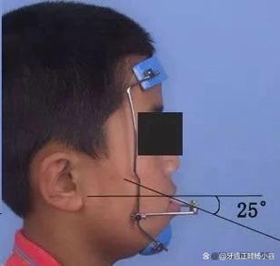 地包天正畸后反弹了怎么办?如何有效处理并预防反弹?-图1 地包天正畸后反弹了怎么办?如何有效处理并预防反弹?-图1
