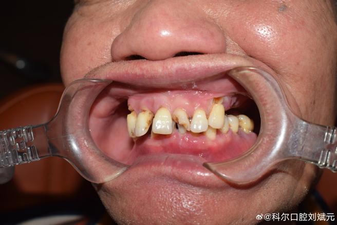 种牙后悔的真实案例，后悔的原因究竟有哪些？-图2