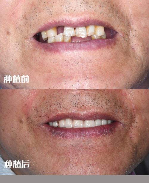 种牙后悔的真实案例，后悔的原因究竟有哪些？-图1