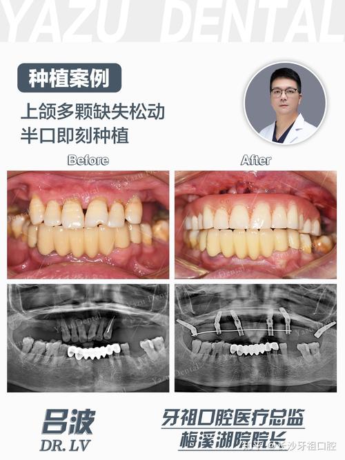 种牙后悔的真实案例，后悔的原因究竟有哪些？-图3