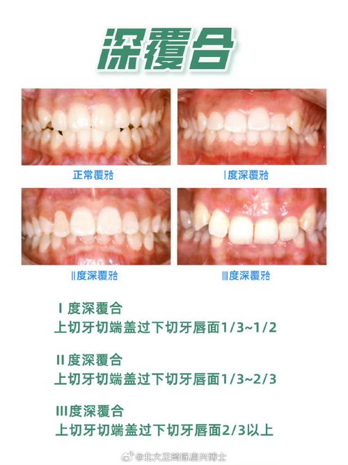骨性深覆颌正畸效果到底好不好？-图2