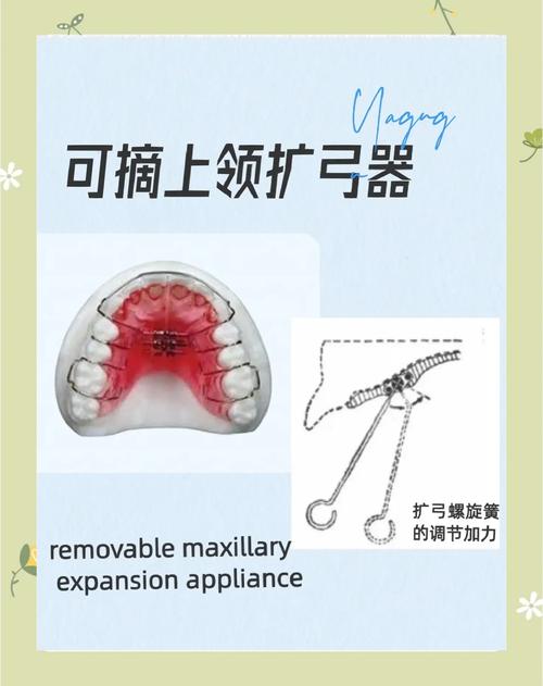 螺旋扩弓器制作方法步骤具体是怎样的?-图1 螺旋扩弓器制作方法步骤具体是怎样的?-图1