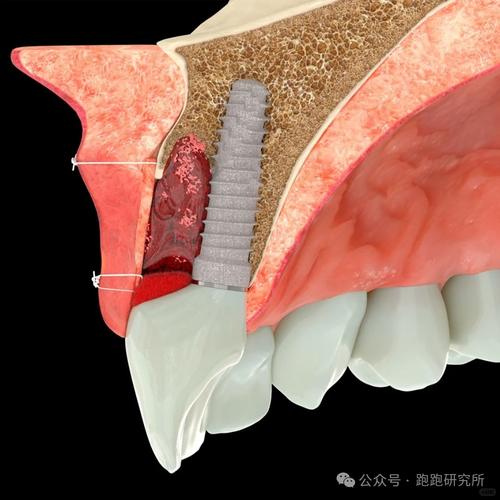 75岁老人种牙可行吗?年龄与身体条件是关键-图1 75岁老人种牙可行吗?年龄与身体条件是关键-图1