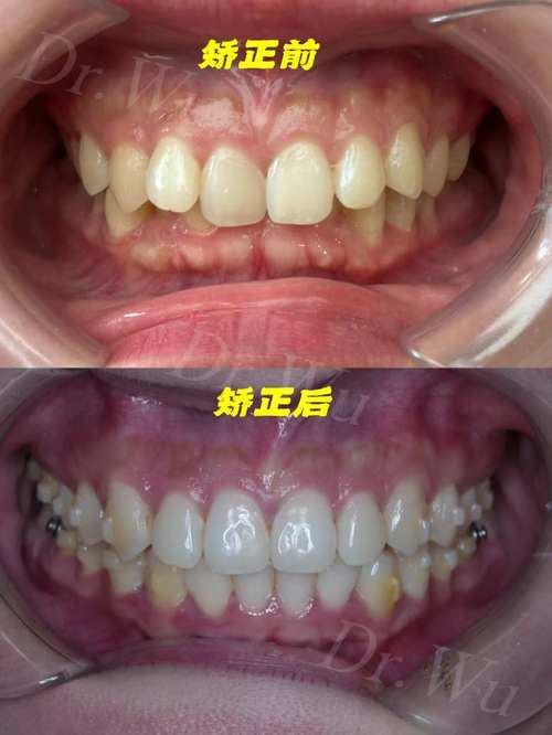 正畸骨性二类有多大效果-图1 正畸骨性二类有多大效果-图1