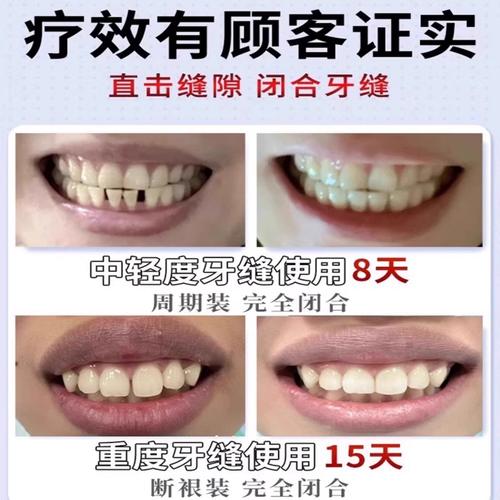 门牙缝隙大如何有效关闭？矫治方法有哪些？-图1