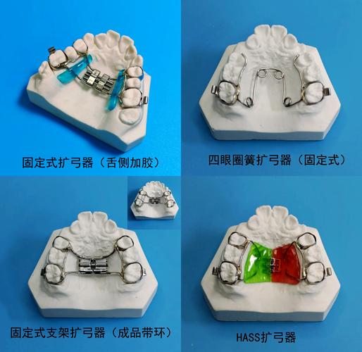牙齿矫正扩弓器如何正确使用?操作步骤、方法及注意事项有哪些?-图1 牙齿矫正扩弓器如何正确使用?操作步骤、方法及注意事项有哪些?-图1