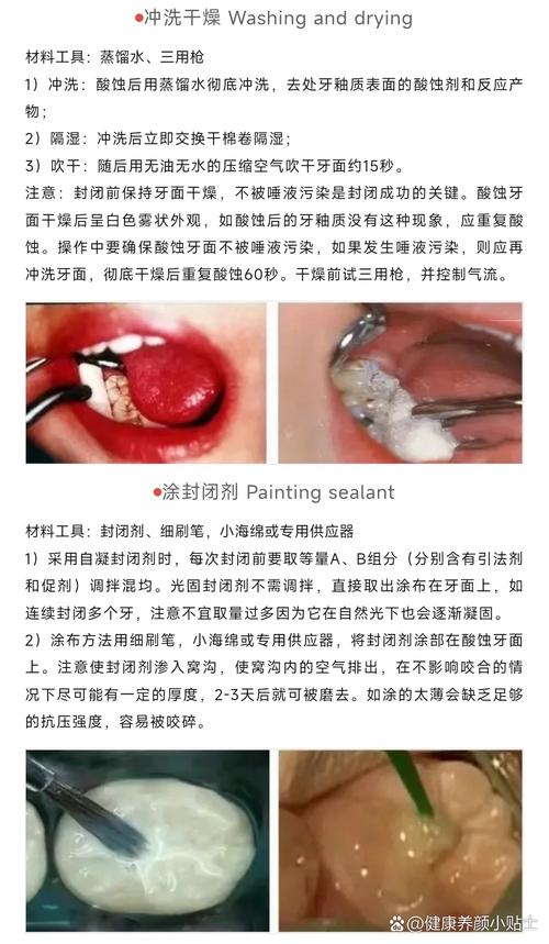 拜博口腔儿童窝沟封闭，真能有效预防儿童蛀牙吗？-图1