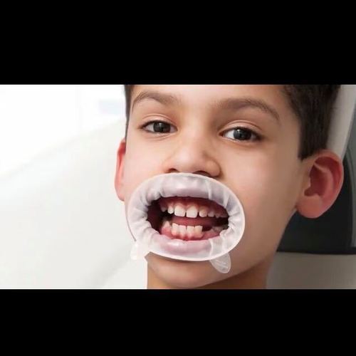 义获嘉开口器的使用方法-图1