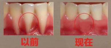 老人牙槽骨萎缩能种牙吗？-图2
