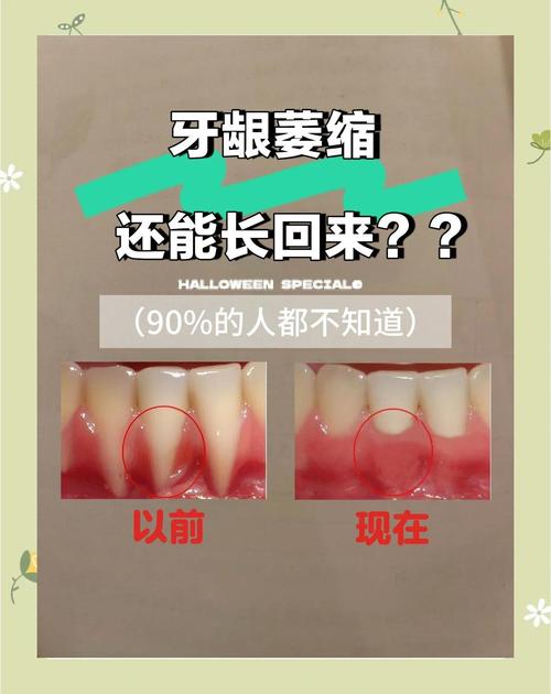老人牙槽骨萎缩能种牙吗?-图1 老人牙槽骨萎缩能种牙吗?-图1