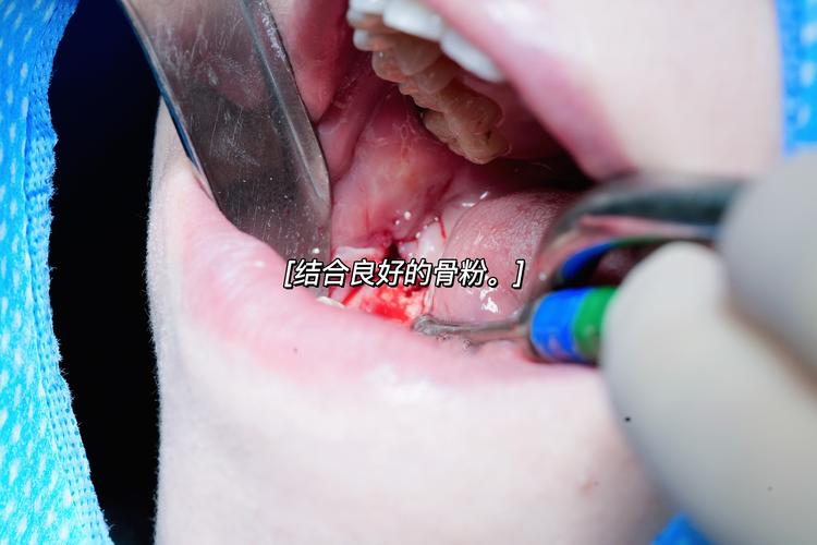 河南矫牙种牙援助计划谁能申请?如何申领?-图1 河南矫牙种牙援助计划谁能申请?如何申领?-图1